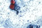 news_cyclosporiasis_72026649176