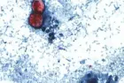 cdc_cyclosporiasis_081226384346