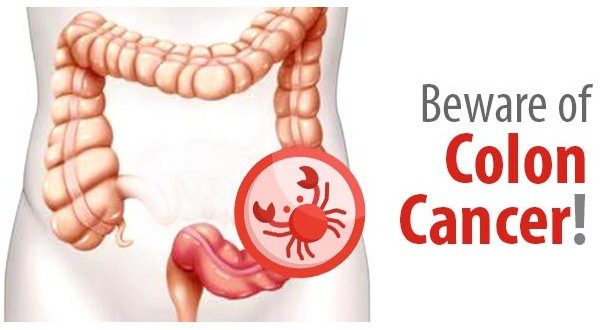 wireready_06-09-2022-10-34-03_00004_bewareofcoloncancer