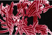 wireready_10-29-2023-11-22-13_00060_tuberculosis