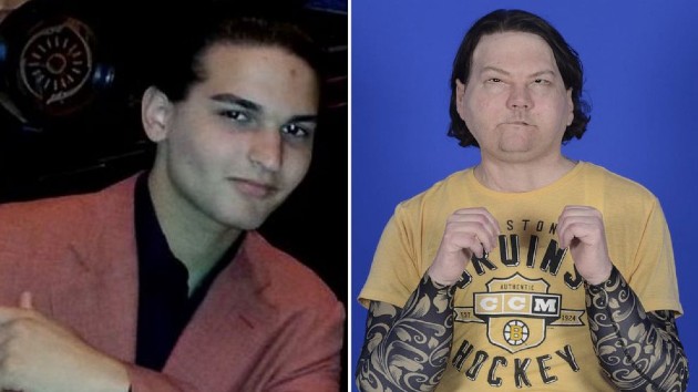 Man Undergoes First Successful Face Double Hand Transplant From Same Donor Ksro