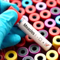 positive Measles vile /test. shows colorful vials in background