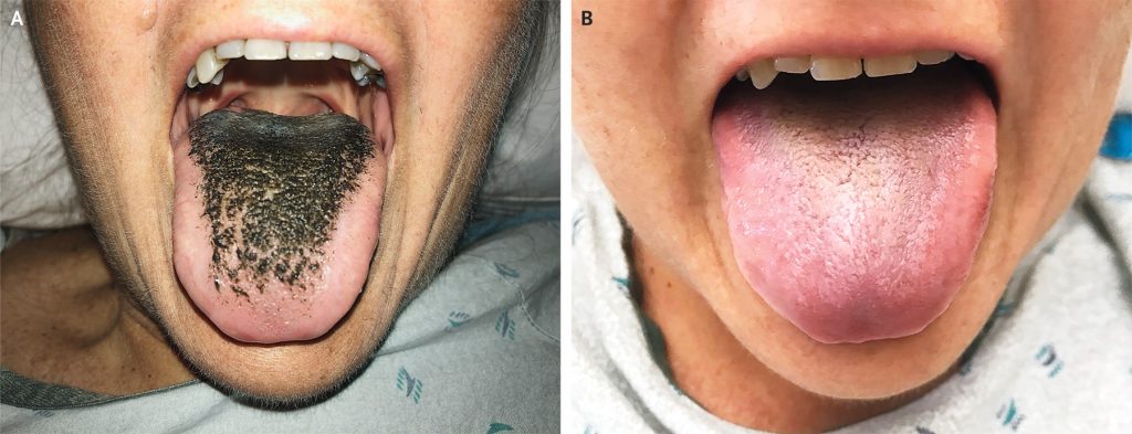 Woman has hairy tongue