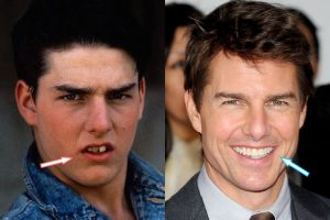 tom cruise teeth