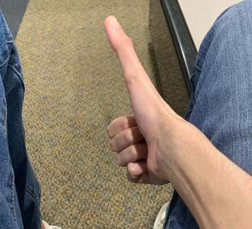 kid with 5 inch thumb