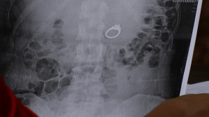 xray-of-ring-in-womans-stomach-png