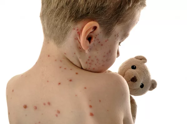 measles-logo-2
