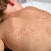 child with measles lying on the bed /asleep.