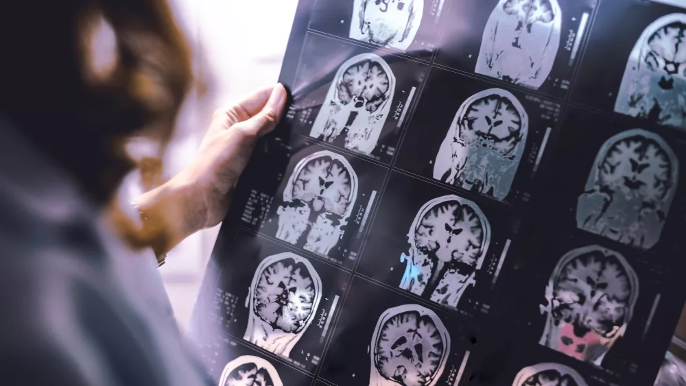 brain-atrophy-on-mri-of-dementia-patient