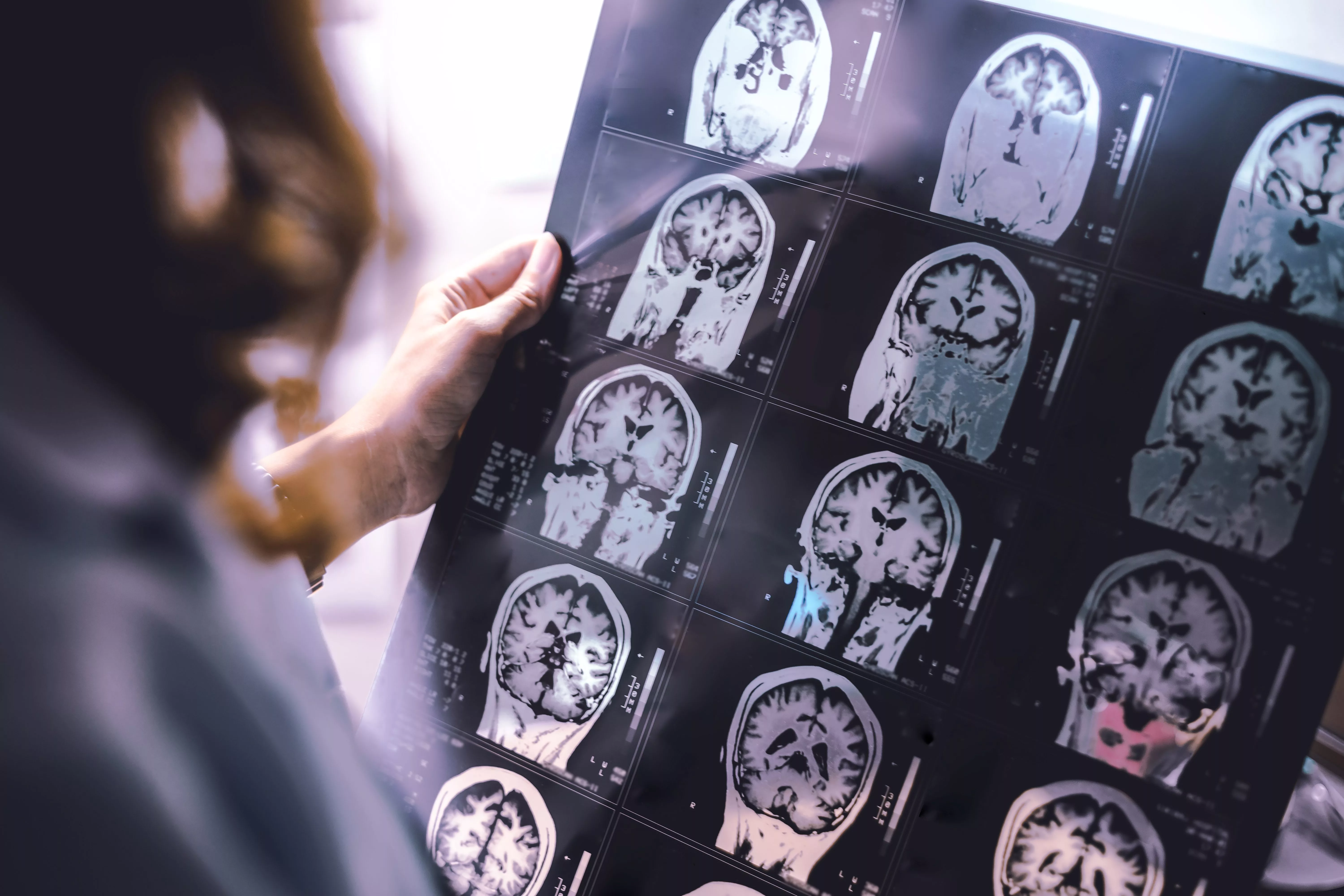 brain-atrophy-on-mri-of-dementia-patient
