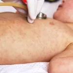 Viral disease. Measles rash. Concept doctor and patient. Child with viral infection measles and doctor with stethoscope