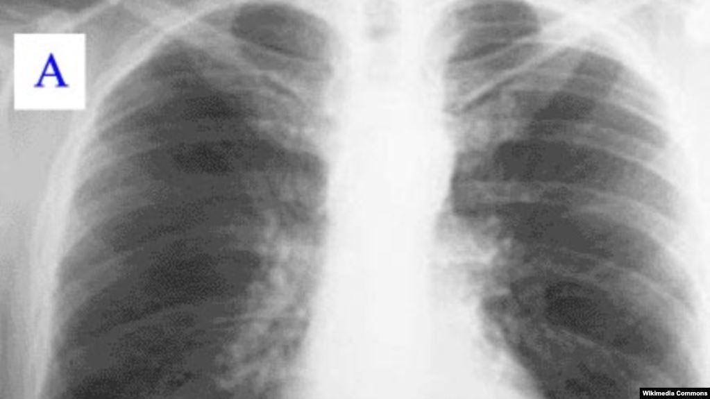 lungs