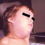 mumps-cdc-website