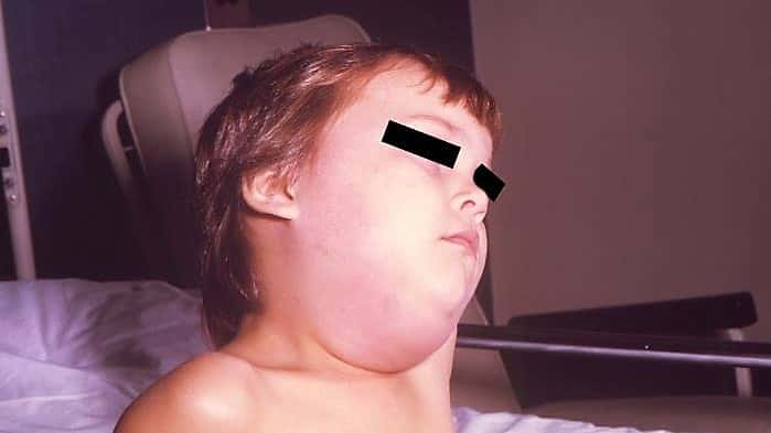 mumps-cdc-website