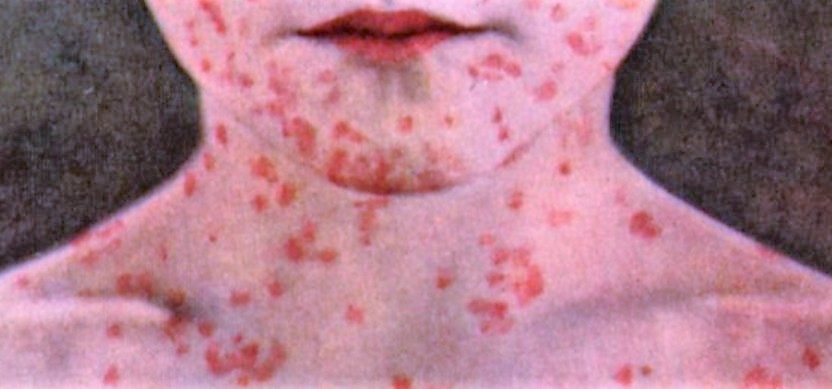 measles-tarrant-county-health-dept-website