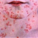 measles-tarrant-county-health-dept-website