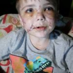 conner-landers-dog-attack-pcso-facebook