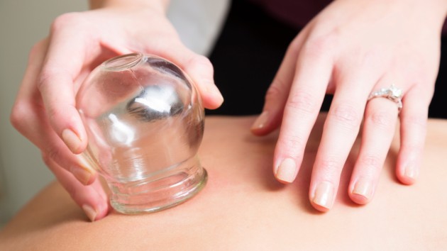 istock_9519_cupping