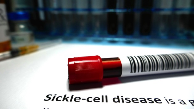 istock_092121_sicklecell